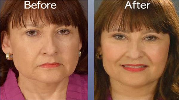 Instant Face and Neck Lift - Image 5