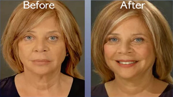 Instant Face and Neck Lift - Nigel Beauty